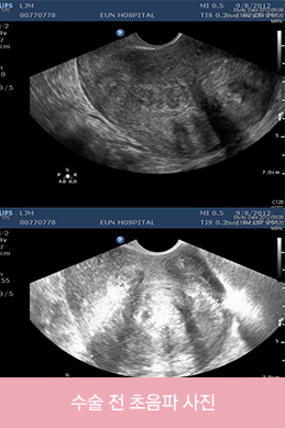 수술 전 초음파 사진