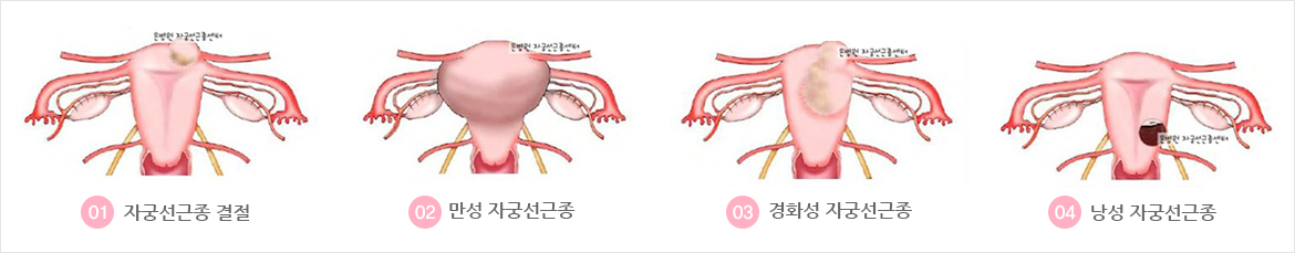 위치에 따른 다양한 자궁근종 종류