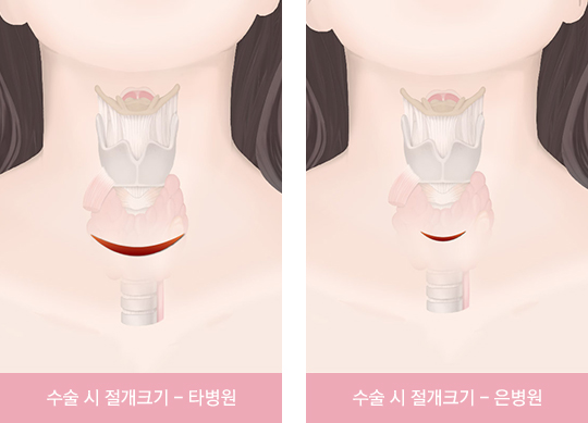 수술 시 절개크기 비교