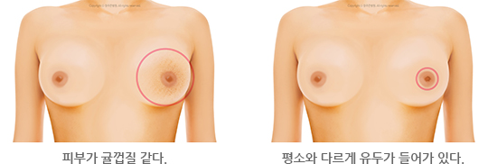 피부가 귤껍질 같다. /  평소와 다르게 유두가 들어가 있다.