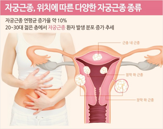 위치에 따른 다양한 자궁근종 종류