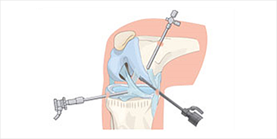 관절경수술이란?