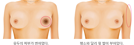 유두의 피부가 변하였다. / 평소와 달리 윗 팔이 부어있다.