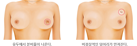 유두에서 분비물이 나온다. / 비정상적인 덩어리가 만져진다.