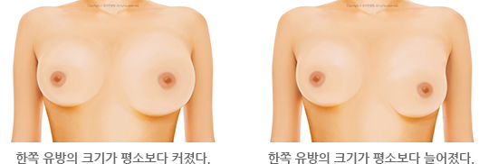 한쪽 유방의 크기가 평소보다 커졌다. /  한쪽 유방의 크기가 평소보다 늘어졌다.