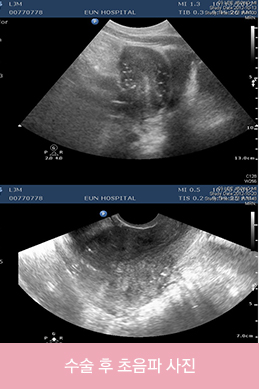 수술 후 초음파 사진